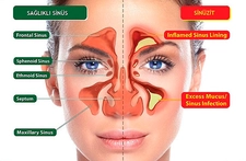 Geniz Akıntısı Nedenleri